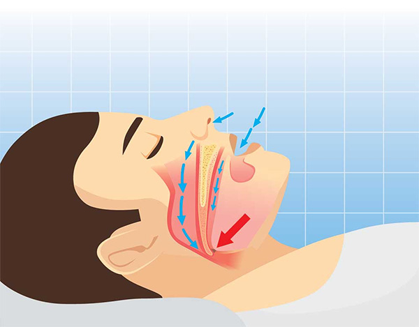A diagram of the airway while you lay down