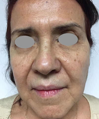 Before - Case 1